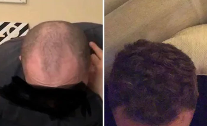  before people their after loss hair 