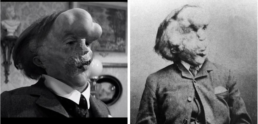 John Hurt As Joseph Merrick In The Elephant Man