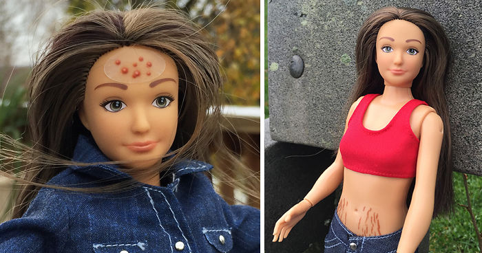 “Normal Barbie” Has Realistic 19-Year-Old Body Shape With Acne, Bruises And Stretch Marks