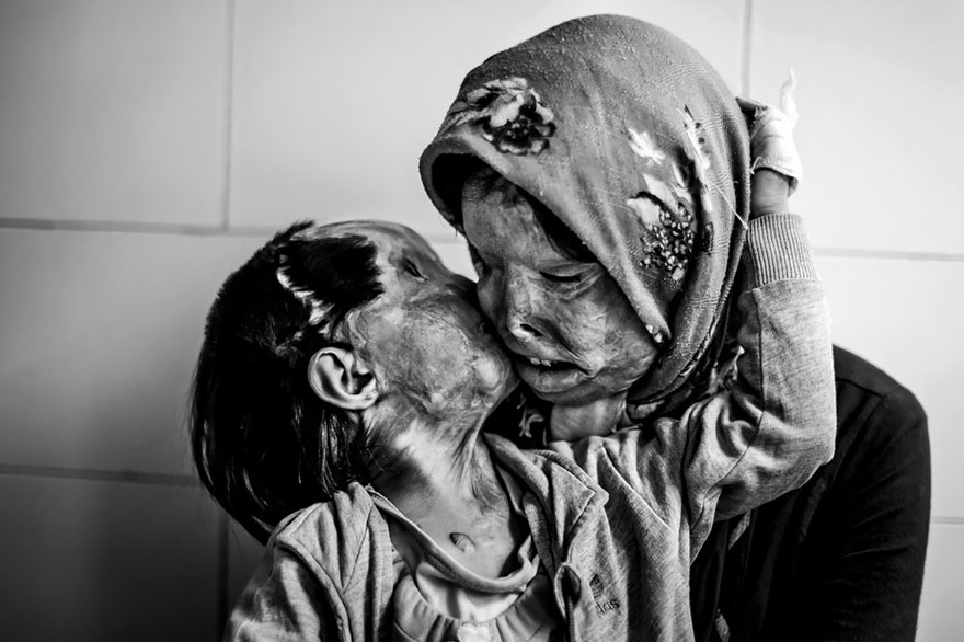 Somayeh Mehri (29) And Her Daughter Rana Afghanipour (3) Give Each Other A Kiss. After Being Disfigured In An Acid Attack, They Say Others Don’t Like To Kiss Them