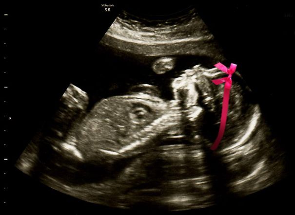 "we're Having A Girl!"