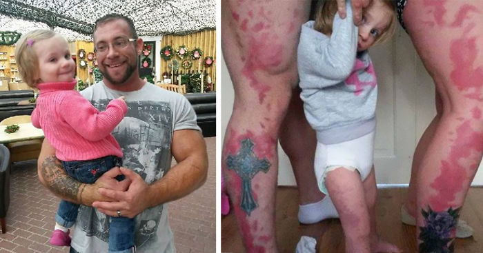 Parents Tattoo Their Legs With Daughter’s Birthmark So She Won’t Feel Different