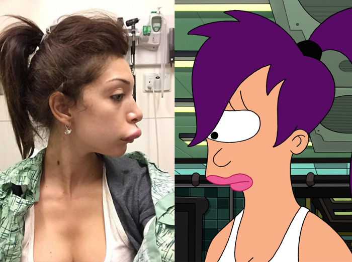 Girl After Plastic Surgery Looks Like Leela From Futurama