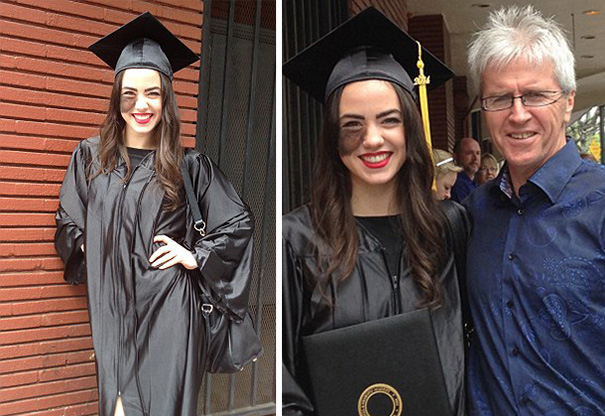 Picture of dancer Cassandra Naud with birthmark under her left eye graduating and picture with father