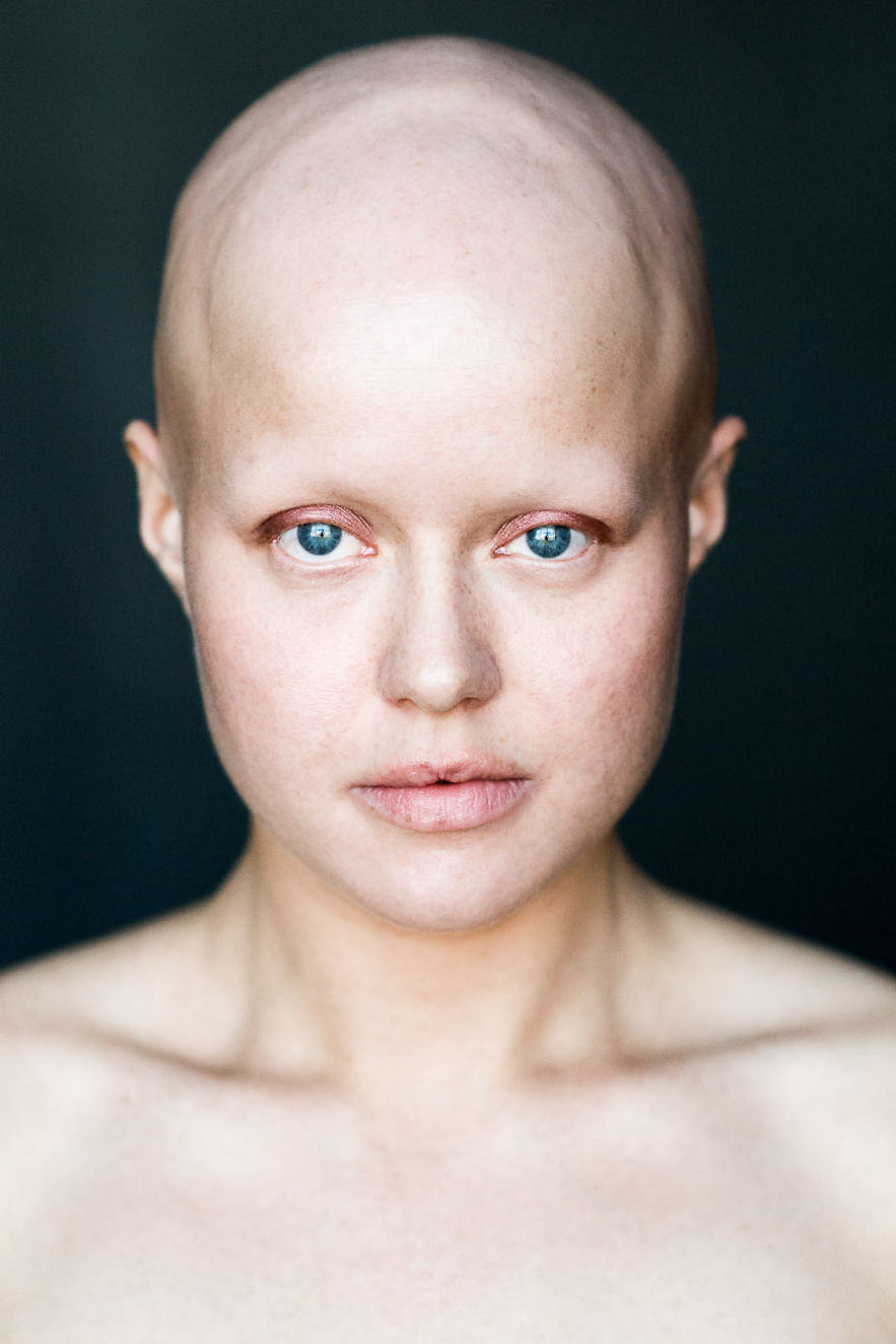 Baldvin: I Photograph Women With Alopecia To Break Gender Stereotypes