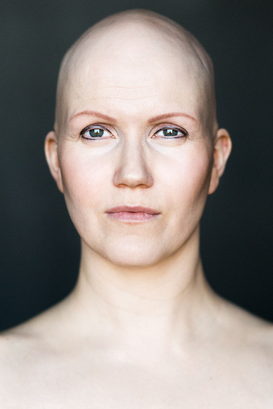 Baldvin: I Photograph Women With Alopecia To Break Gender Stereotypes