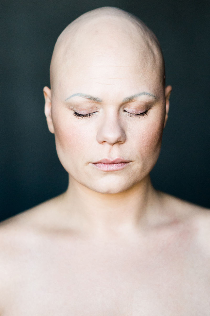 Baldvin: I Photograph Women With Alopecia To Break Gender Stereotypes