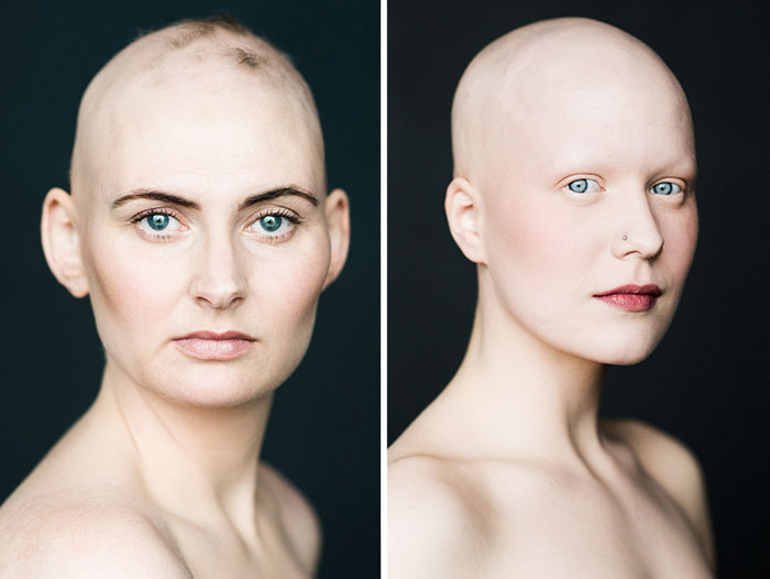 Baldvin: I Photograph Women With Alopecia To Break Gender Stereotypes