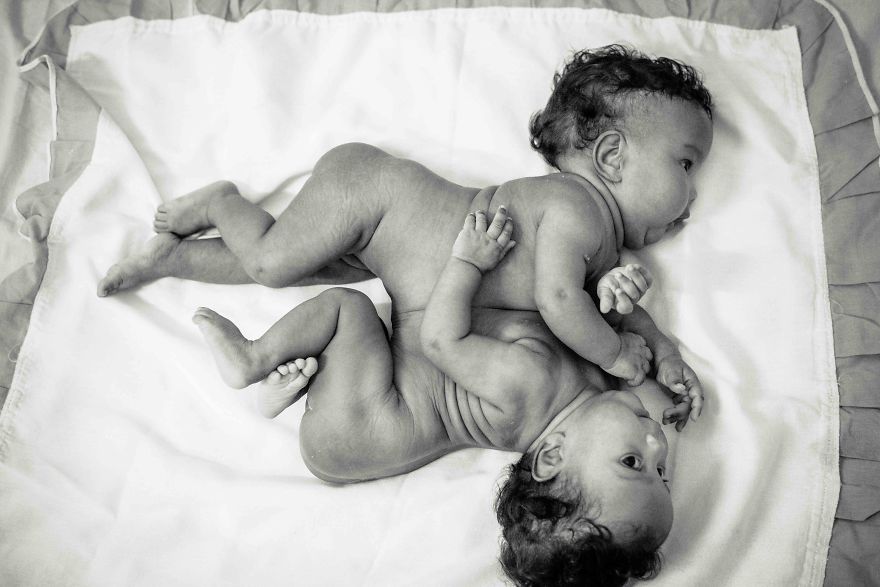 These 2-Months-Old Conjoined Twins Share One Liver And I Had The Honor To P...