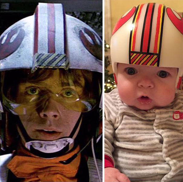 craniosynostosis-helmet-star-wars-kid-2