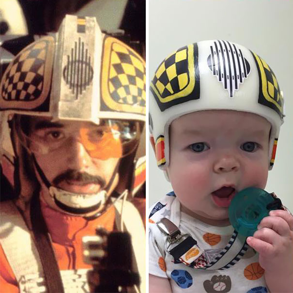 craniosynostosis-helmet-star-wars-kid-3