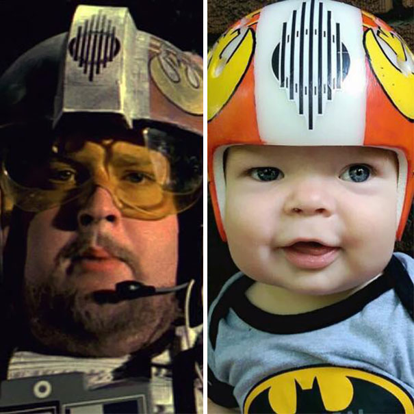 craniosynostosis-helmet-star-wars-kid-4