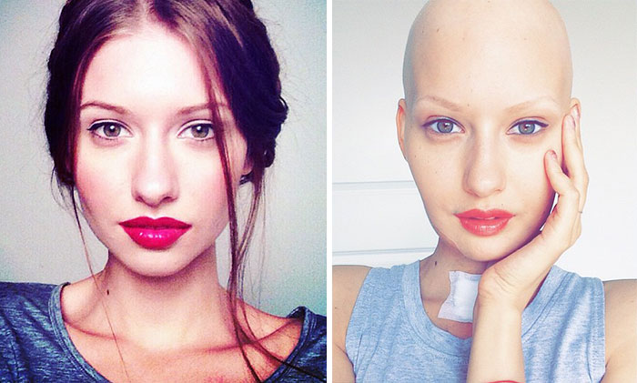 Doctors Told Model To Abort Her Child After She Lost 95% Of Her Jaw To Cancer. This Is What She Did