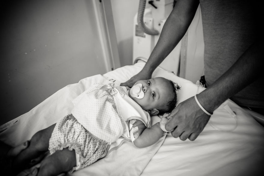 Conjoined Twins After Separation Surgery