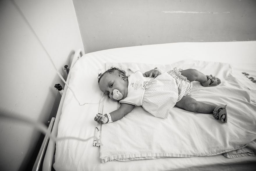 Conjoined Twins After Separation Surgery Conjoined Twins After Separation Surgery