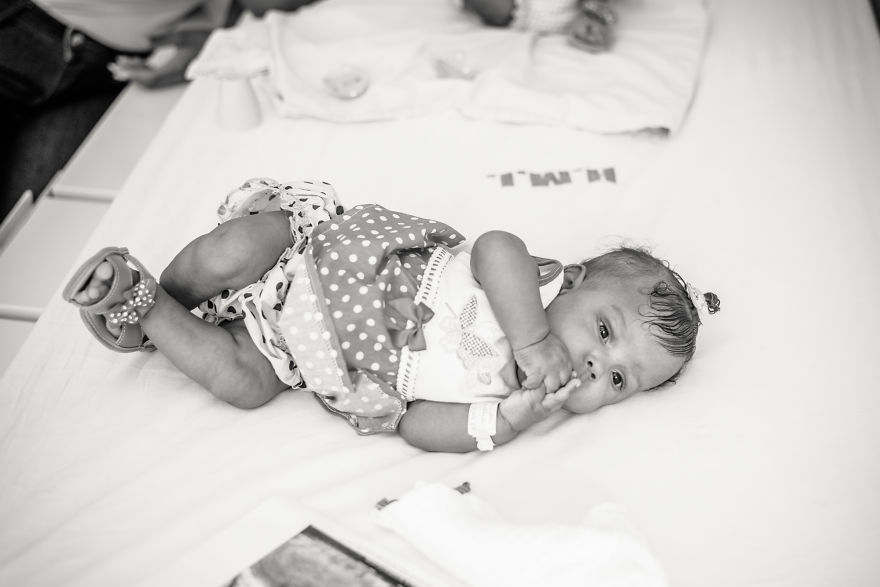 Conjoined Twins After Separation Surgery Conjoined Twins After Separation Surgery