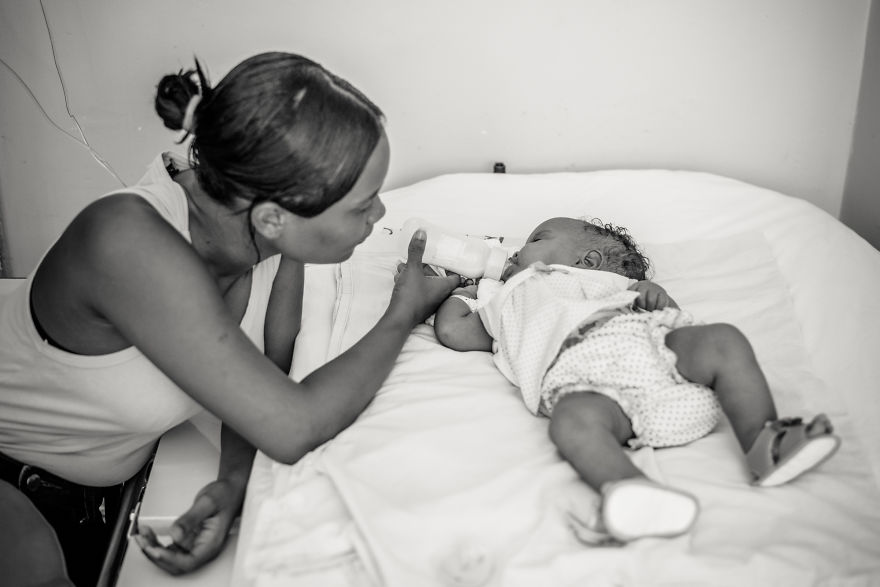 Conjoined Twins After Separation Surgery Conjoined Twins After Separation Surgery