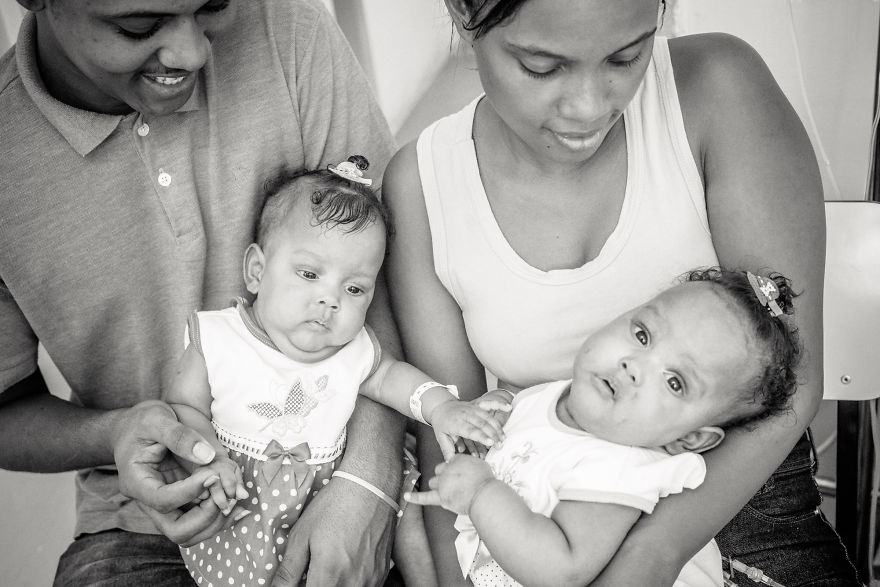 Conjoined Twins After Separation Surgery Conjoined Twins After Separation Surgery