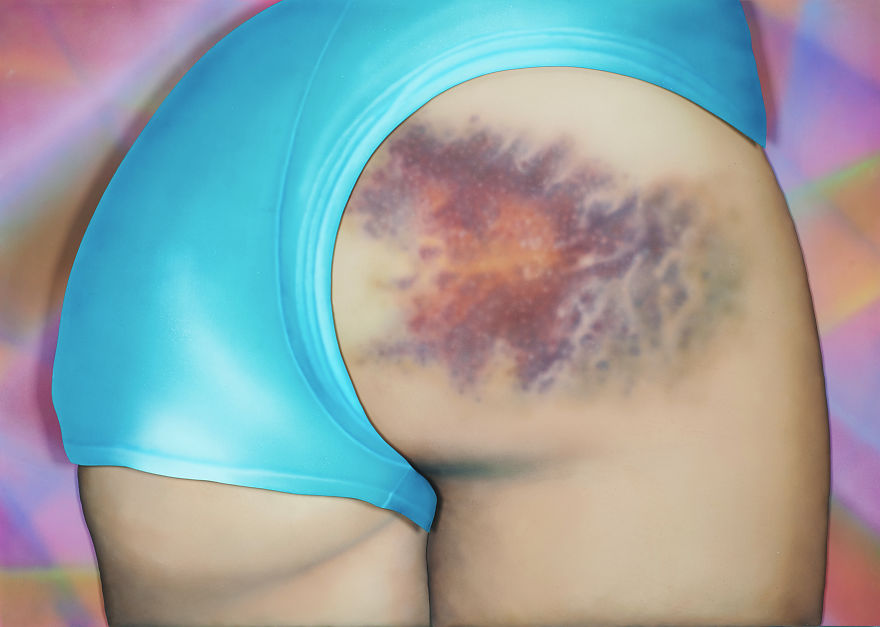 The Beauty Of Bruises: I Captured These Mini-Galaxies On The Butts Of Roller-Derby Girls The Beauty Of Bruises: I Captured These Mini-Galaxies On The Butts Of Roller-Derby Girls