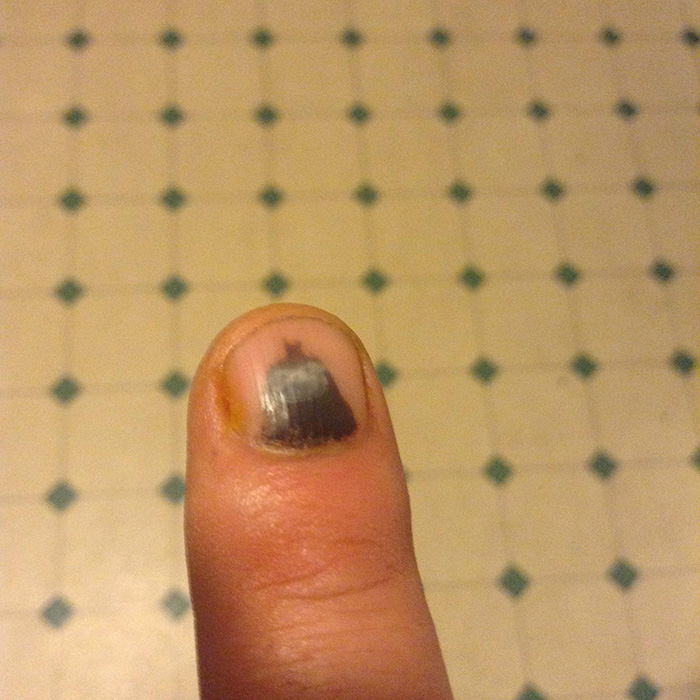 My Smashed Finger Looks Like Batman And A Little Like A Sloth