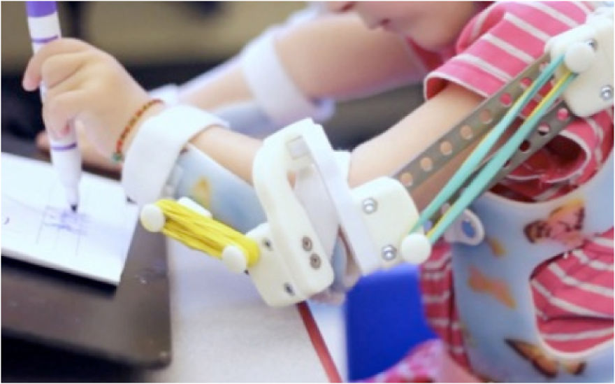 Magic Arms: 3D-Printed Device Helps People With Rare Conditions Move Their Arms Magic Arms: 3D-Printed Device Helps People With Rare Conditions Move Their Arms