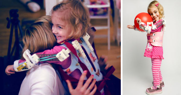 Magic Arms: 3D-Printed Device Helps People With Rare Conditions Move Their Arms