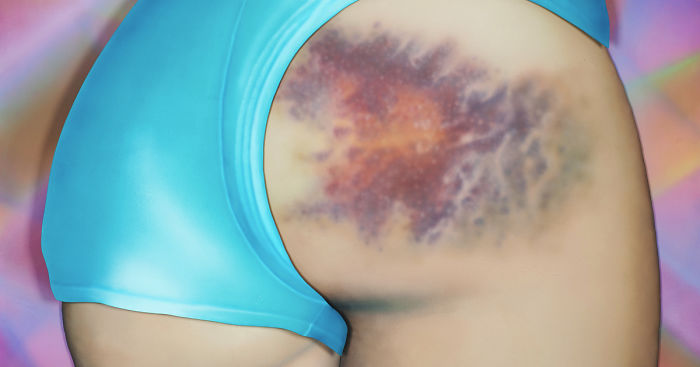 The Beauty Of Bruises: I Captured These Mini-Galaxies On The Butts Of Roller-Derby Girls