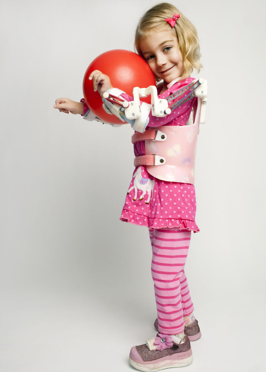 Magic Arms: 3D-Printed Device Helps People With Rare Conditions Move Their Arms