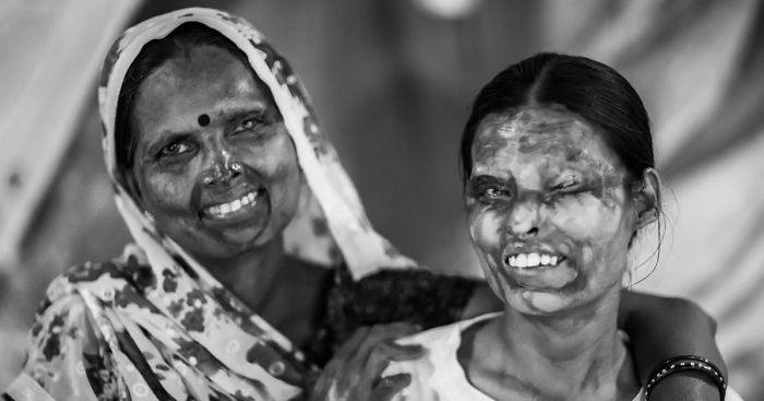 I Took Portraits Of Acid Attacks Survivors In India