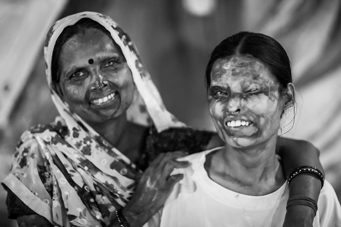 I Took Portraits Of Acid Attacks Survivors In India