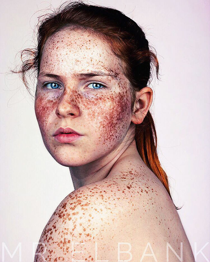 Freckles