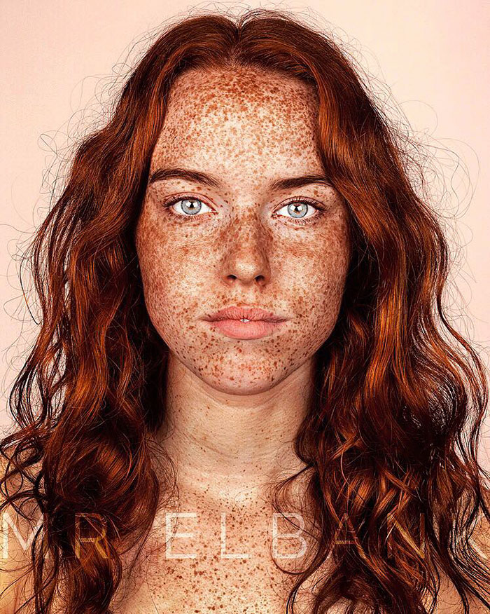 Freckles