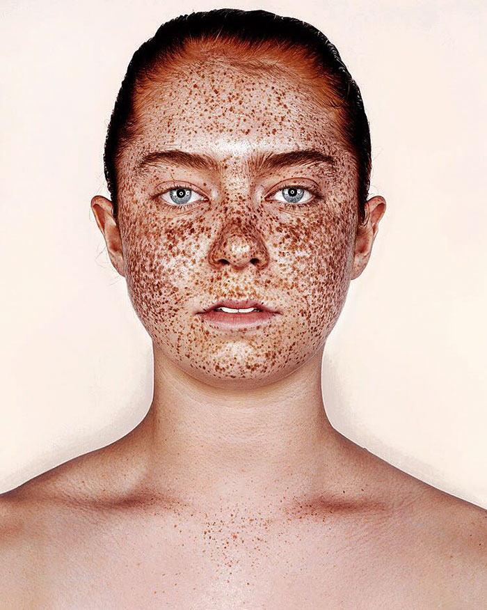 Freckles