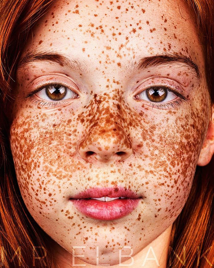 Freckles