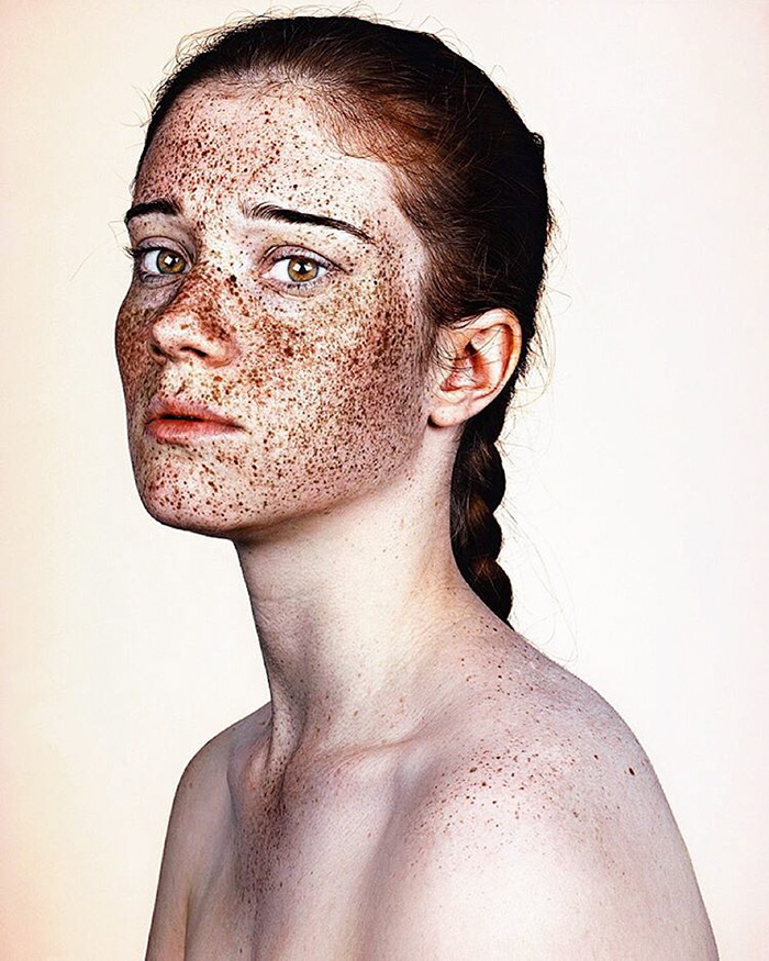 Freckles