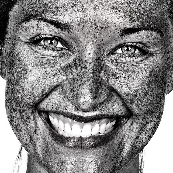 Freckles