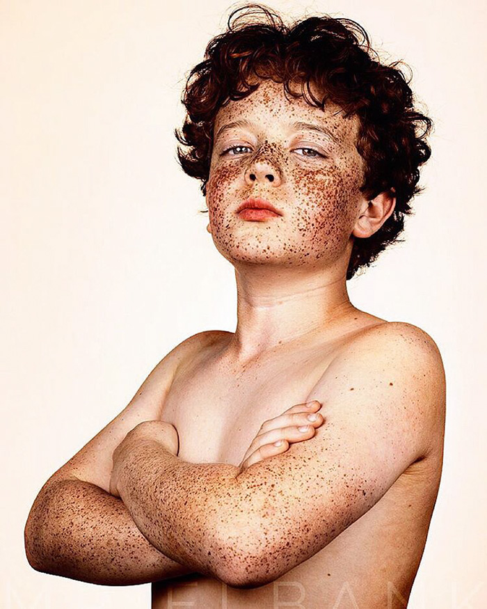 Freckles