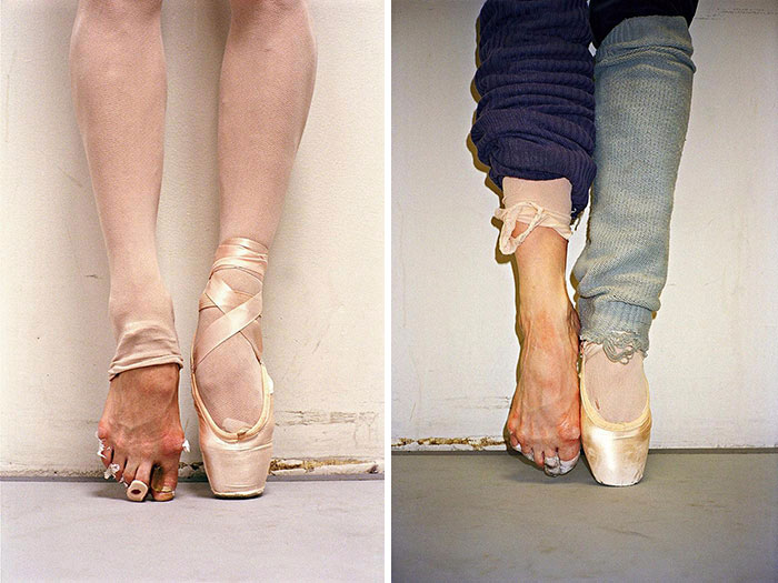 Ballet dancer's feet showcasing the intense physical cost of the art, with damaged toes and pointe shoes.
