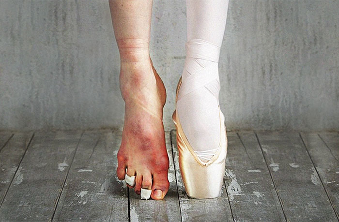 Ballet dancer’s feet, one bare with injuries and one in a pointe shoe, illustrating the cost of applause in ballet.