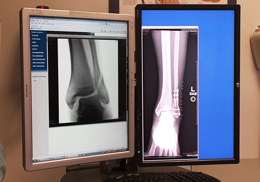 This Revolutionary 3d Printed Cast, Called Boomcast, Is Totally Badass This Revolutionary 3d Printed Cast, Called Boomcast, Is Totally Badass