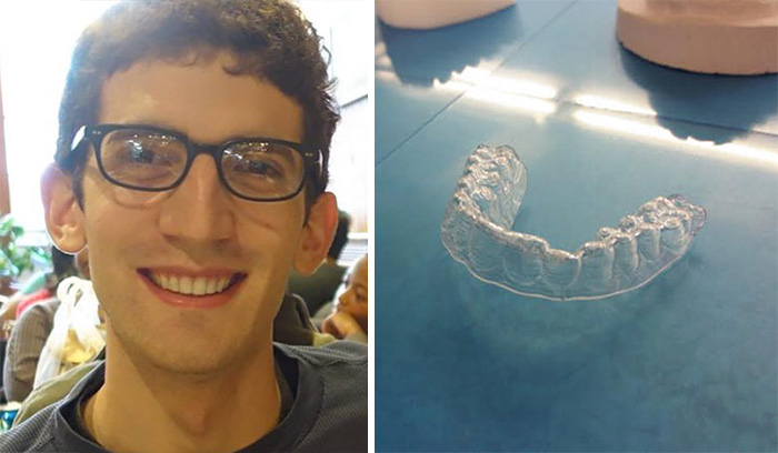 3d-printed-braces-amos-dudley-1