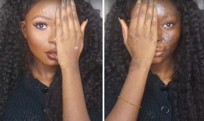 Burn Survivor Bullied At School Becomes Makeup Artist To Help Other Victims