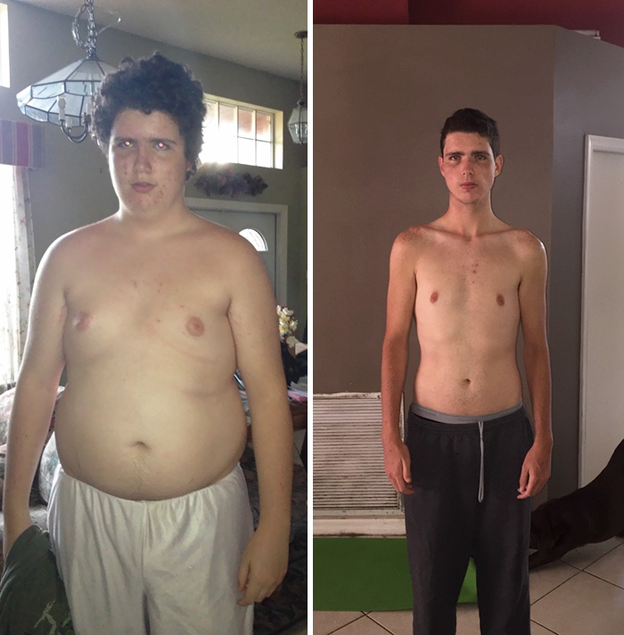 Похудел после операции. Похудение после бариатрической операции. Люди до и после бариатрической операции. Пластическая операция после похудения мужчин. Живот до и после похудения.