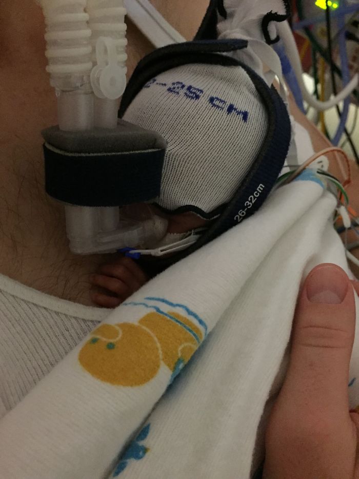 Kangaroo Care With Our Little 27 Week Preemie