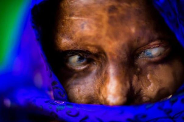 Women Have Opened A Cafe In India For Fellow Victims Of Acid Attacks Women Have Opened A Cafe In India For Fellow Victims Of Acid Attacks