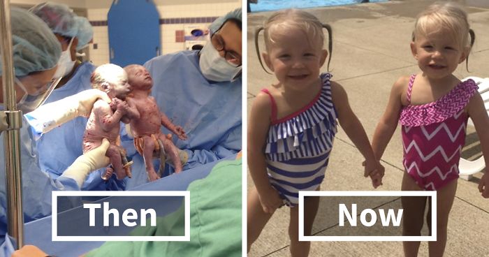 Twins Born Holding Hands Are Now Closer Than EverTwins Born Holding Hands Are Now Closer Than Ever