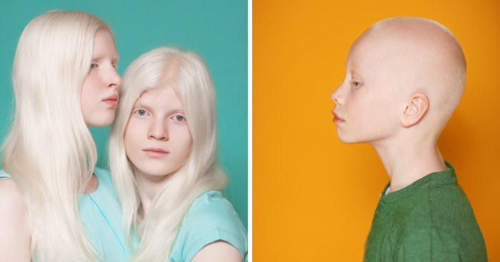 We Took Photographs Of Albino Kids To Show Their Pure Beauty