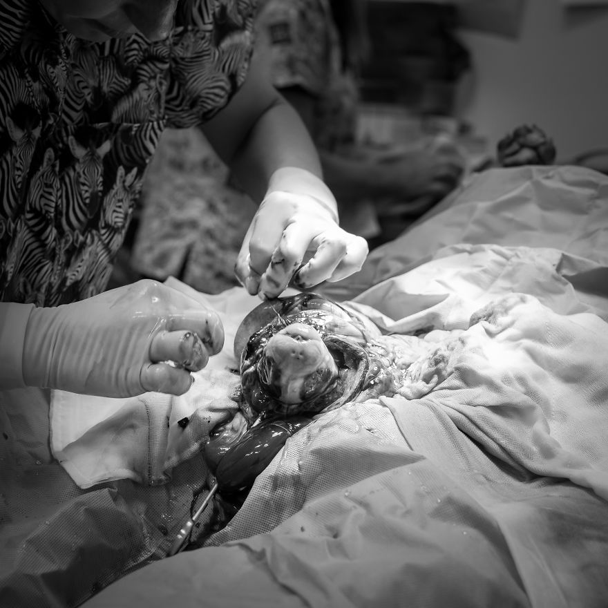 I Documented Bulldog C-Section