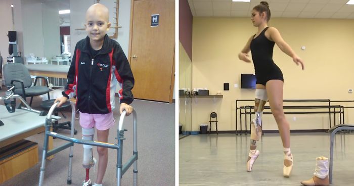 15-Year-Old Amputee Ballerina Who Lost Her Leg To Cancer, Makes An Unbelievable Recovery