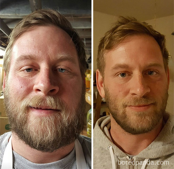 Before and after comparison of a man showing changes after stopping drinking.
